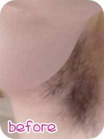 トリアでのワキ脱毛経過写真です。こちらは使用前の写真でもじゃもじゃですが、１年足らずできれいになりました。脱毛のことなら、わたしのおまかせ！ケノンとトリアで全身脱毛したゆきにゃんの脱毛ブログです☆